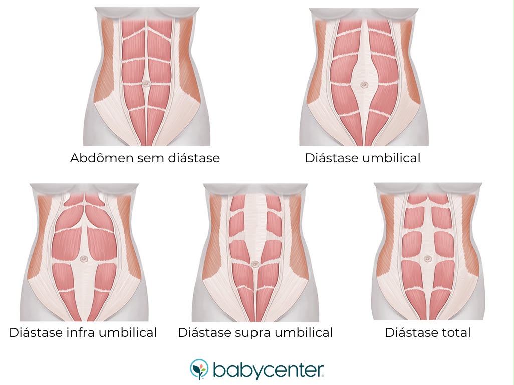 Ilustração dos tipos de diástase abdominal: sem diástase, umbilical, infra umbilical, supra umbilical e total